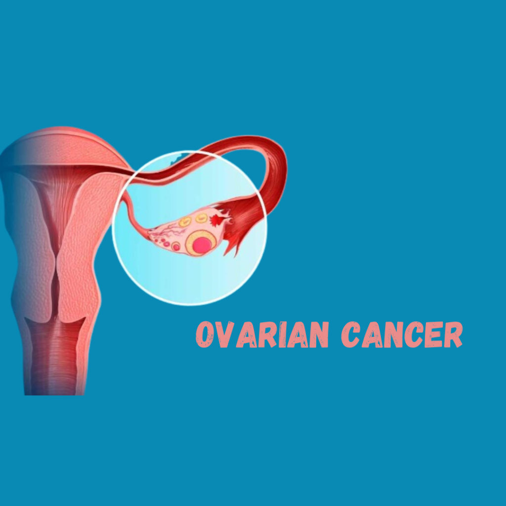 How to detect Ovarian cancer Early.?