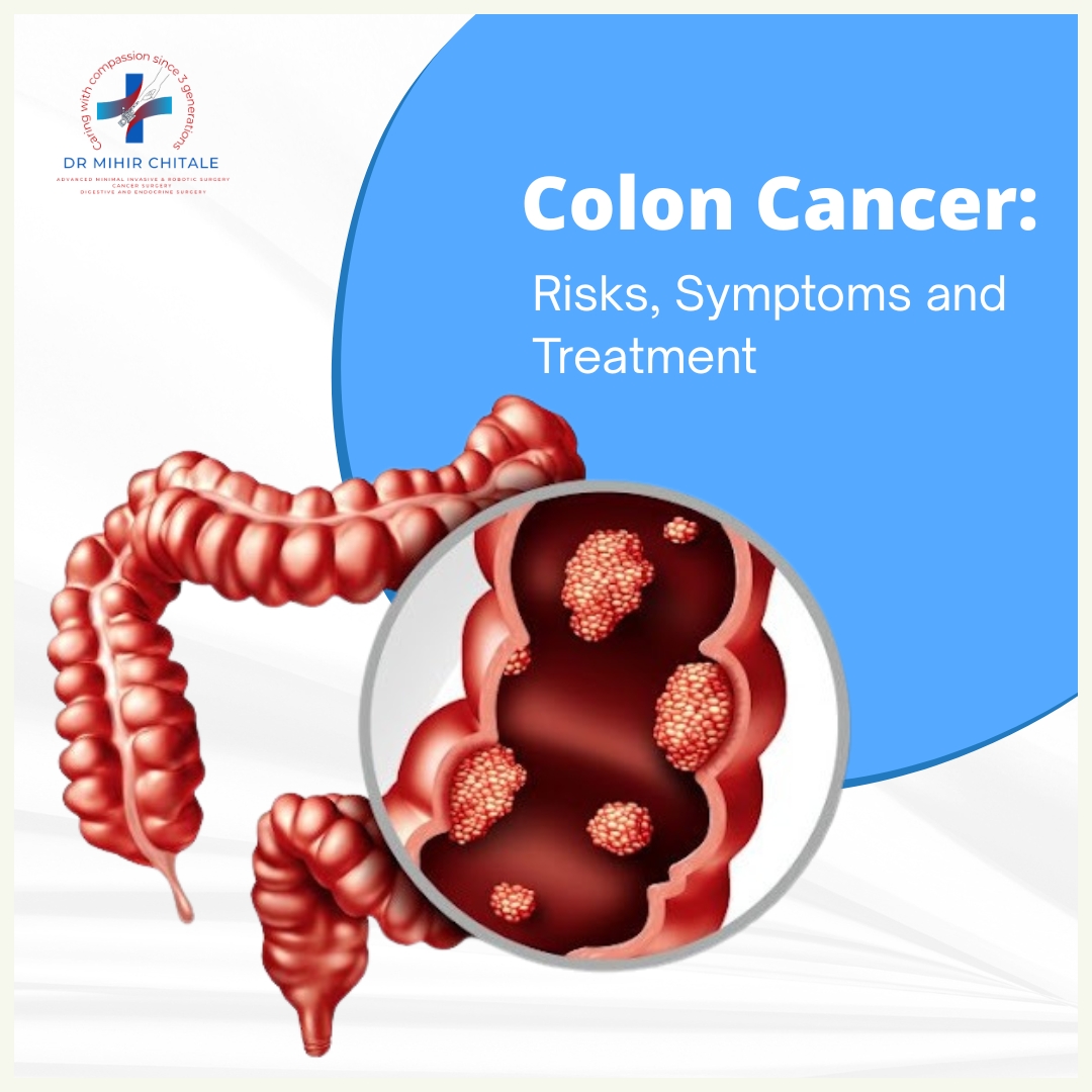 Colon Cancer: Risks, Symptoms and Treatment