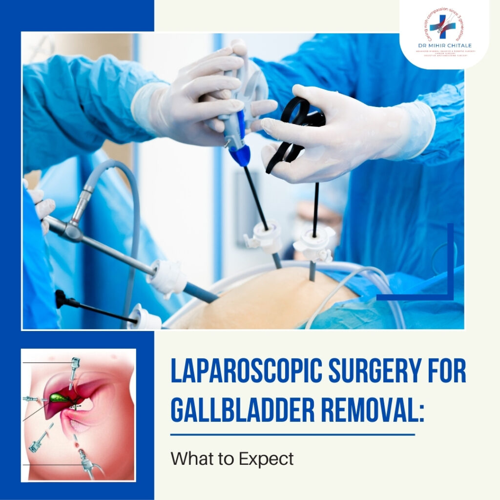 Laparoscopic Surgery for Gallbladder Removal: What to Expect
