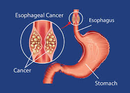 Esophagus Cancer